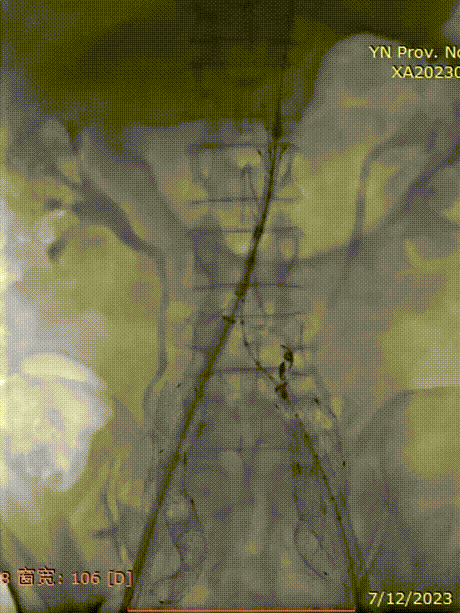 gore医疗怎么样「漫腹精论」双股动脉入路，纯腔内保双髂——GORE® EXCLUDER® 髂动脉分支型覆膜支架（IBE）治疗双侧髂总动脉_https://www.jmylbn.com_新闻资讯_第31张