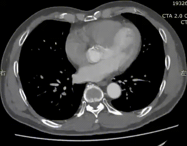 gore医疗怎么样「漫腹精论」双股动脉入路，纯腔内保双髂——GORE® EXCLUDER® 髂动脉分支型覆膜支架（IBE）治疗双侧髂总动脉_https://www.jmylbn.com_新闻资讯_第5张