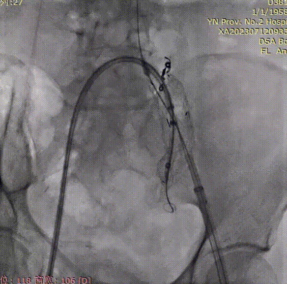 gore医疗怎么样「漫腹精论」双股动脉入路，纯腔内保双髂——GORE® EXCLUDER® 髂动脉分支型覆膜支架（IBE）治疗双侧髂总动脉_https://www.jmylbn.com_新闻资讯_第19张