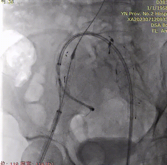 gore医疗怎么样「漫腹精论」双股动脉入路，纯腔内保双髂——GORE® EXCLUDER® 髂动脉分支型覆膜支架（IBE）治疗双侧髂总动脉_https://www.jmylbn.com_新闻资讯_第25张