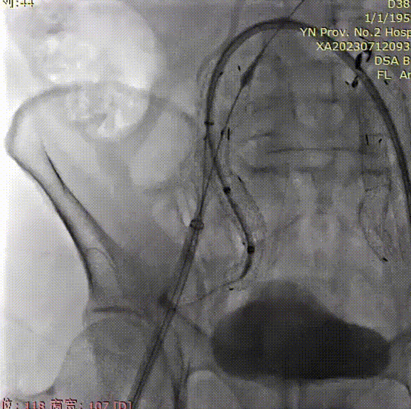 gore医疗怎么样「漫腹精论」双股动脉入路，纯腔内保双髂——GORE® EXCLUDER® 髂动脉分支型覆膜支架（IBE）治疗双侧髂总动脉_https://www.jmylbn.com_新闻资讯_第27张