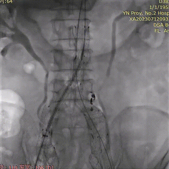 gore医疗怎么样「漫腹精论」双股动脉入路，纯腔内保双髂——GORE® EXCLUDER® 髂动脉分支型覆膜支架（IBE）治疗双侧髂总动脉_https://www.jmylbn.com_新闻资讯_第35张