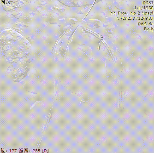 gore医疗怎么样「漫腹精论」双股动脉入路，纯腔内保双髂——GORE® EXCLUDER® 髂动脉分支型覆膜支架（IBE）治疗双侧髂总动脉_https://www.jmylbn.com_新闻资讯_第24张