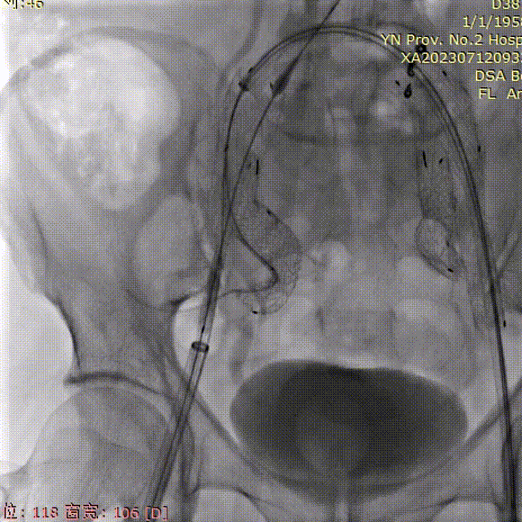 gore医疗怎么样「漫腹精论」双股动脉入路，纯腔内保双髂——GORE® EXCLUDER® 髂动脉分支型覆膜支架（IBE）治疗双侧髂总动脉_https://www.jmylbn.com_新闻资讯_第28张