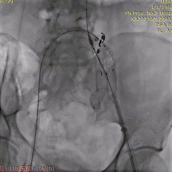 gore医疗怎么样「漫腹精论」双股动脉入路，纯腔内保双髂——GORE® EXCLUDER® 髂动脉分支型覆膜支架（IBE）治疗双侧髂总动脉_https://www.jmylbn.com_新闻资讯_第20张