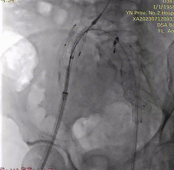 gore医疗怎么样「漫腹精论」双股动脉入路，纯腔内保双髂——GORE® EXCLUDER® 髂动脉分支型覆膜支架（IBE）治疗双侧髂总动脉_https://www.jmylbn.com_新闻资讯_第22张