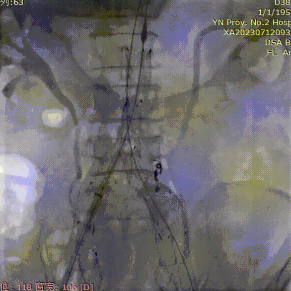gore医疗怎么样「漫腹精论」双股动脉入路，纯腔内保双髂——GORE® EXCLUDER® 髂动脉分支型覆膜支架（IBE）治疗双侧髂总动脉_https://www.jmylbn.com_新闻资讯_第34张