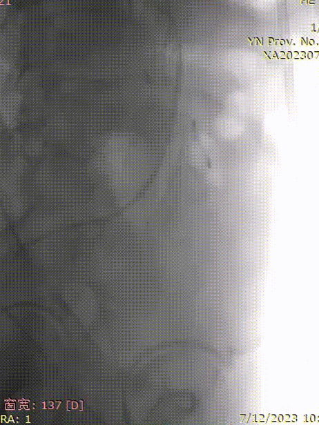 gore医疗怎么样「漫腹精论」双股动脉入路，纯腔内保双髂——GORE® EXCLUDER® 髂动脉分支型覆膜支架（IBE）治疗双侧髂总动脉_https://www.jmylbn.com_新闻资讯_第12张