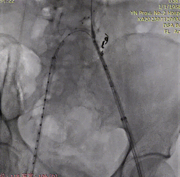 gore医疗怎么样「漫腹精论」双股动脉入路，纯腔内保双髂——GORE® EXCLUDER® 髂动脉分支型覆膜支架（IBE）治疗双侧髂总动脉_https://www.jmylbn.com_新闻资讯_第15张