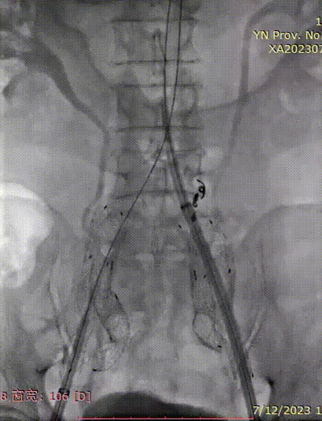 gore医疗怎么样「漫腹精论」双股动脉入路，纯腔内保双髂——GORE® EXCLUDER® 髂动脉分支型覆膜支架（IBE）治疗双侧髂总动脉_https://www.jmylbn.com_新闻资讯_第29张