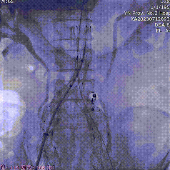 gore医疗怎么样「漫腹精论」双股动脉入路，纯腔内保双髂——GORE® EXCLUDER® 髂动脉分支型覆膜支架（IBE）治疗双侧髂总动脉_https://www.jmylbn.com_新闻资讯_第36张