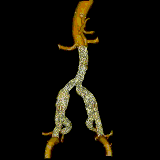 gore医疗怎么样「漫腹精论」双股动脉入路，纯腔内保双髂——GORE® EXCLUDER® 髂动脉分支型覆膜支架（IBE）治疗双侧髂总动脉_https://www.jmylbn.com_新闻资讯_第39张