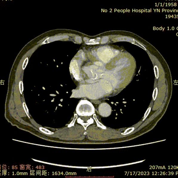 gore医疗怎么样「漫腹精论」双股动脉入路，纯腔内保双髂——GORE® EXCLUDER® 髂动脉分支型覆膜支架（IBE）治疗双侧髂总动脉_https://www.jmylbn.com_新闻资讯_第38张