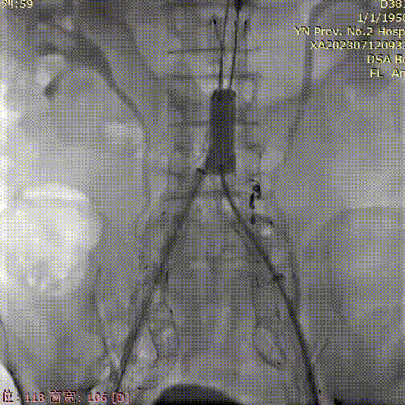 gore医疗怎么样「漫腹精论」双股动脉入路，纯腔内保双髂——GORE® EXCLUDER® 髂动脉分支型覆膜支架（IBE）治疗双侧髂总动脉_https://www.jmylbn.com_新闻资讯_第33张