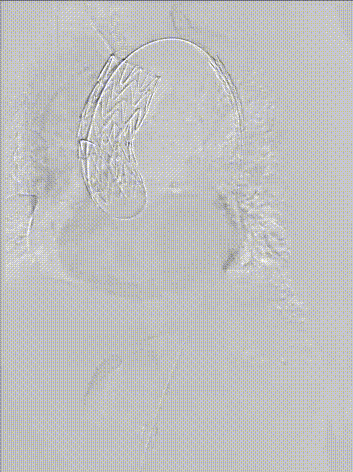 gore医疗怎么样「胸有乾坤」异“区”同“功” 精准定位——GORE® TAG® 可主动调控胸主动脉覆膜支架治疗升主动脉穿透性溃疡病例报道_https://www.jmylbn.com_新闻资讯_第17张