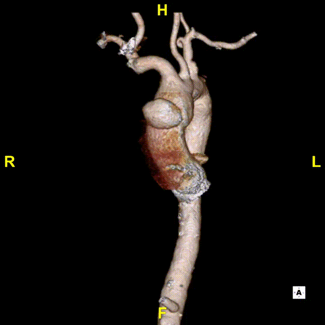 gore医疗怎么样「胸有乾坤」异“区”同“功” 精准定位——GORE® TAG® 可主动调控胸主动脉覆膜支架治疗升主动脉穿透性溃疡病例报道_https://www.jmylbn.com_新闻资讯_第8张