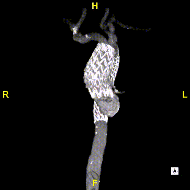 gore医疗怎么样「胸有乾坤」异“区”同“功” 精准定位——GORE® TAG® 可主动调控胸主动脉覆膜支架治疗升主动脉穿透性溃疡病例报道_https://www.jmylbn.com_新闻资讯_第21张