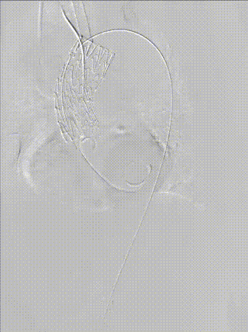 gore医疗怎么样「胸有乾坤」异“区”同“功” 精准定位——GORE® TAG® 可主动调控胸主动脉覆膜支架治疗升主动脉穿透性溃疡病例报道_https://www.jmylbn.com_新闻资讯_第16张