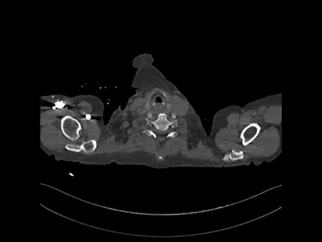 gore医疗怎么样「胸有乾坤」异“区”同“功” 精准定位——GORE® TAG® 可主动调控胸主动脉覆膜支架治疗升主动脉穿透性溃疡病例报道_https://www.jmylbn.com_新闻资讯_第19张