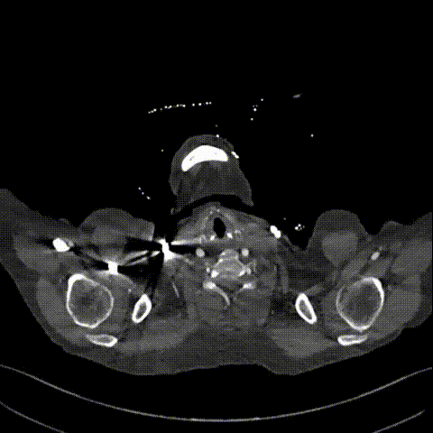 gore医疗怎么样「胸有乾坤」异“区”同“功” 精准定位——GORE® TAG® 可主动调控胸主动脉覆膜支架治疗升主动脉穿透性溃疡病例报道_https://www.jmylbn.com_新闻资讯_第7张