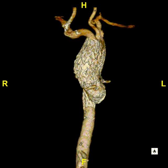 gore医疗怎么样「胸有乾坤」异“区”同“功” 精准定位——GORE® TAG® 可主动调控胸主动脉覆膜支架治疗升主动脉穿透性溃疡病例报道_https://www.jmylbn.com_新闻资讯_第20张