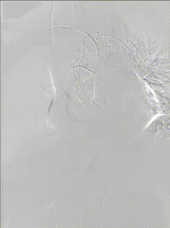 gore医疗怎么样「胸有乾坤」异“区”同“功” 精准定位——GORE® TAG® 可主动调控胸主动脉覆膜支架治疗升主动脉穿透性溃疡病例报道_https://www.jmylbn.com_新闻资讯_第18张