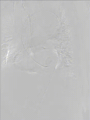 gore医疗怎么样「胸有乾坤」异“区”同“功” 精准定位——GORE® TAG® 可主动调控胸主动脉覆膜支架治疗升主动脉穿透性溃疡病例报道_https://www.jmylbn.com_新闻资讯_第15张