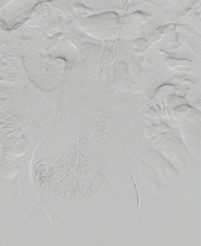 gore医疗怎么样「漫腹精论」髂合时宜 精益求精——双MOB球囊导管辅助腹主动脉覆膜支架急诊治疗破裂巨大髂动脉瘤_https://www.jmylbn.com_新闻资讯_第27张