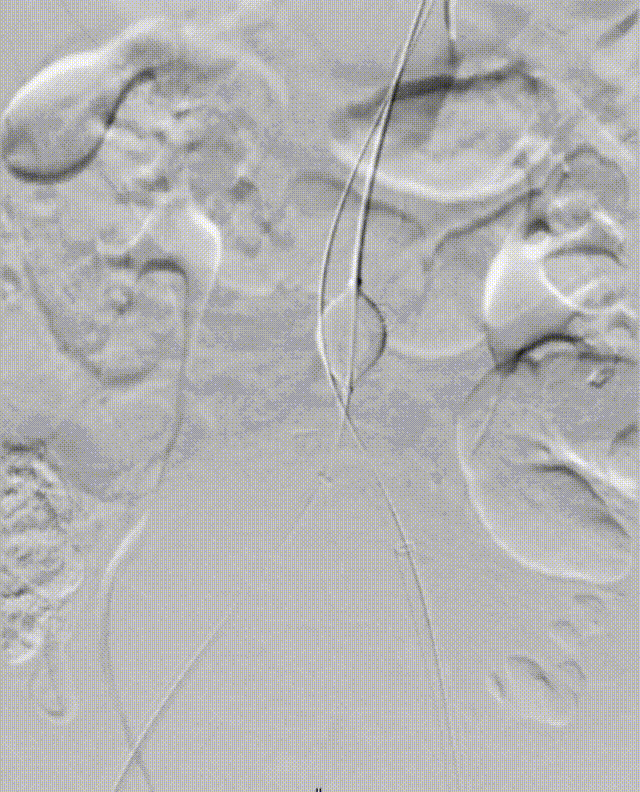 gore医疗怎么样「漫腹精论」髂合时宜 精益求精——双MOB球囊导管辅助腹主动脉覆膜支架急诊治疗破裂巨大髂动脉瘤_https://www.jmylbn.com_新闻资讯_第17张