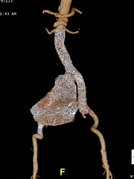 gore医疗怎么样「漫腹精论」髂合时宜 精益求精——双MOB球囊导管辅助腹主动脉覆膜支架急诊治疗破裂巨大髂动脉瘤_https://www.jmylbn.com_新闻资讯_第29张