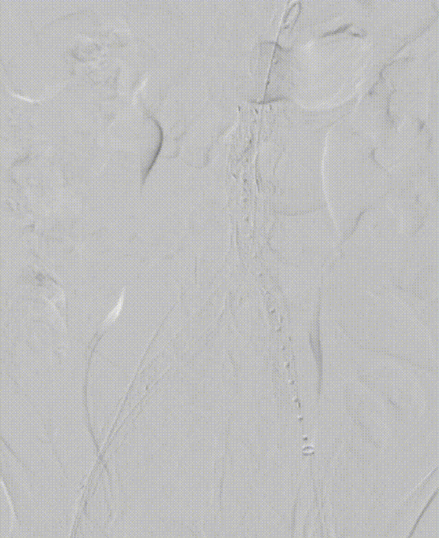 gore医疗怎么样「漫腹精论」髂合时宜 精益求精——双MOB球囊导管辅助腹主动脉覆膜支架急诊治疗破裂巨大髂动脉瘤_https://www.jmylbn.com_新闻资讯_第25张