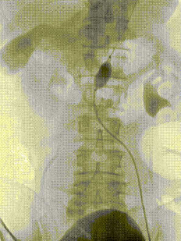 gore医疗怎么样「漫腹精论」髂合时宜 精益求精——双MOB球囊导管辅助腹主动脉覆膜支架急诊治疗破裂巨大髂动脉瘤_https://www.jmylbn.com_新闻资讯_第13张