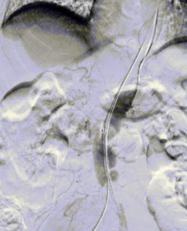 gore医疗怎么样「漫腹精论」髂合时宜 精益求精——双MOB球囊导管辅助腹主动脉覆膜支架急诊治疗破裂巨大髂动脉瘤_https://www.jmylbn.com_新闻资讯_第19张