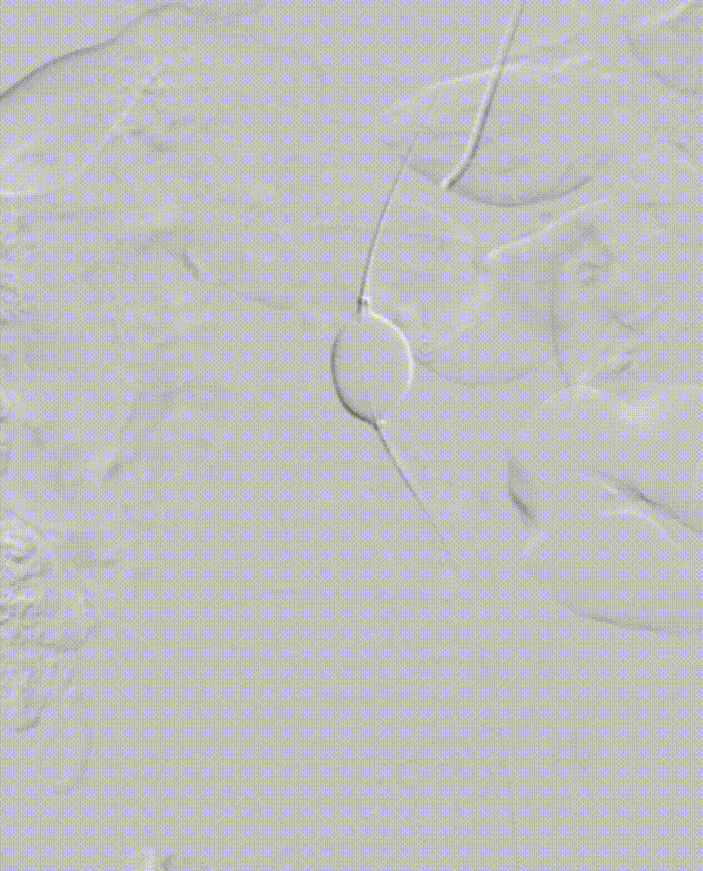 gore医疗怎么样「漫腹精论」髂合时宜 精益求精——双MOB球囊导管辅助腹主动脉覆膜支架急诊治疗破裂巨大髂动脉瘤_https://www.jmylbn.com_新闻资讯_第15张