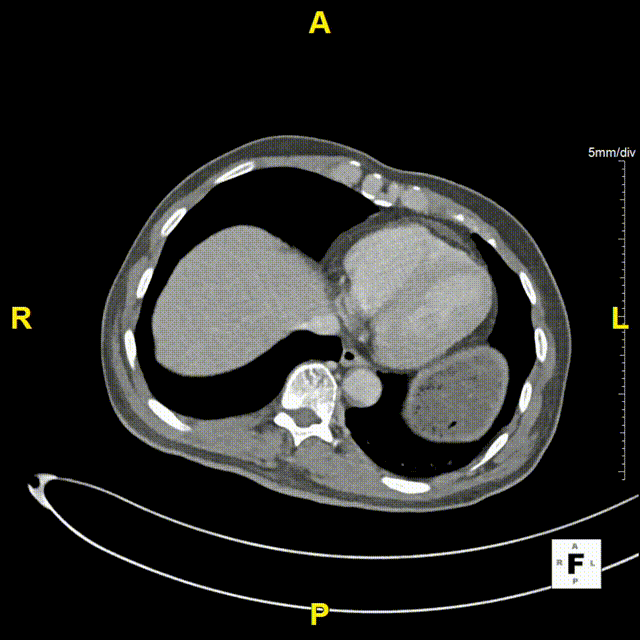 gore医疗怎么样「漫腹精论」髂合时宜 精益求精——双MOB球囊导管辅助腹主动脉覆膜支架急诊治疗破裂巨大髂动脉瘤_https://www.jmylbn.com_新闻资讯_第5张