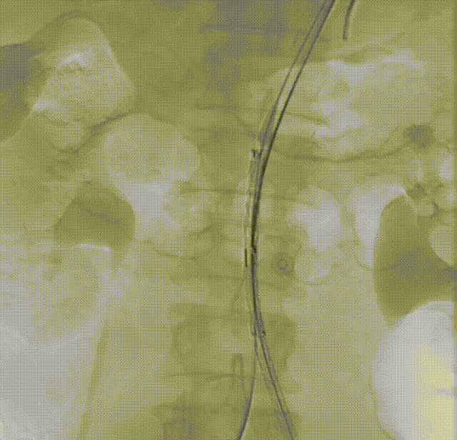 gore医疗怎么样「漫腹精论」髂合时宜 精益求精——双MOB球囊导管辅助腹主动脉覆膜支架急诊治疗破裂巨大髂动脉瘤_https://www.jmylbn.com_新闻资讯_第20张