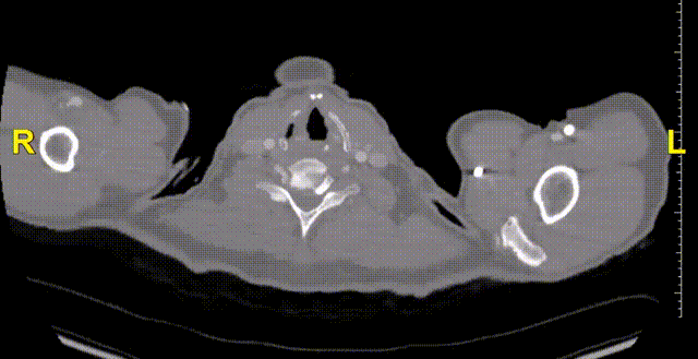 gore医疗怎么样「漫腹精论」髂合时宜 精益求精——双MOB球囊导管辅助腹主动脉覆膜支架急诊治疗破裂巨大髂动脉瘤_https://www.jmylbn.com_新闻资讯_第28张