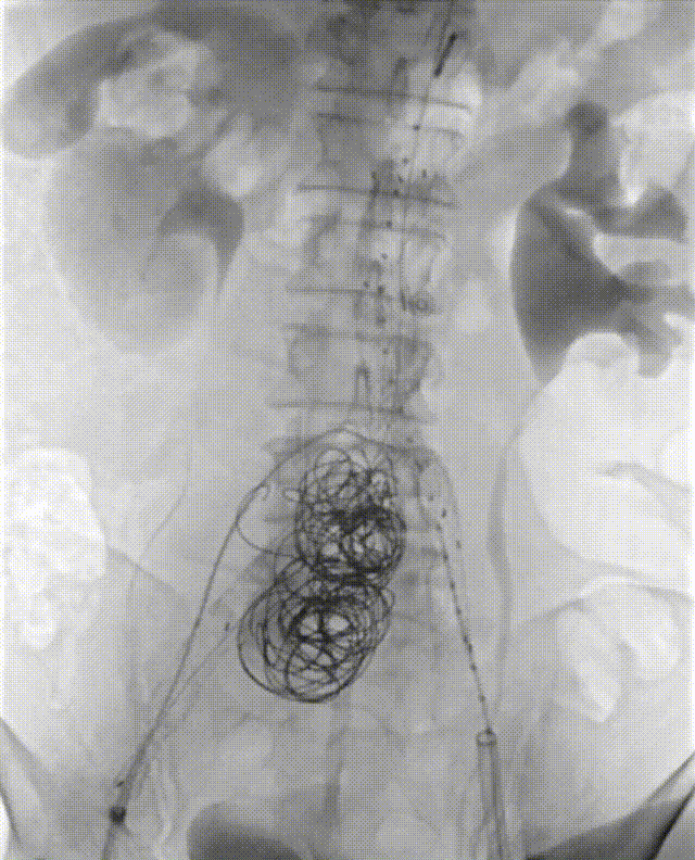 gore医疗怎么样「漫腹精论」髂合时宜 精益求精——双MOB球囊导管辅助腹主动脉覆膜支架急诊治疗破裂巨大髂动脉瘤_https://www.jmylbn.com_新闻资讯_第26张