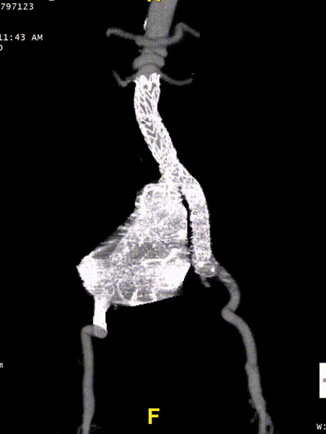 gore医疗怎么样「漫腹精论」髂合时宜 精益求精——双MOB球囊导管辅助腹主动脉覆膜支架急诊治疗破裂巨大髂动脉瘤_https://www.jmylbn.com_新闻资讯_第30张
