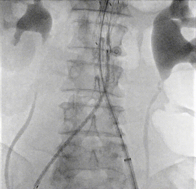 gore医疗怎么样「漫腹精论」髂合时宜 精益求精——双MOB球囊导管辅助腹主动脉覆膜支架急诊治疗破裂巨大髂动脉瘤_https://www.jmylbn.com_新闻资讯_第22张
