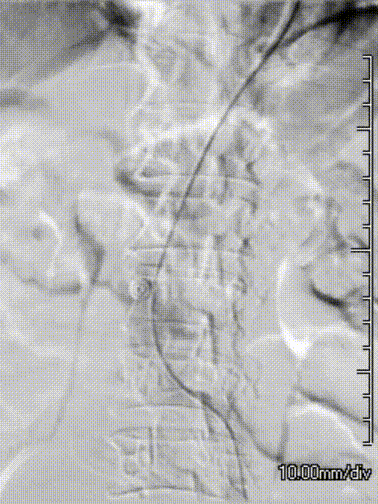 gore医疗怎么样「漫腹精论」髂合时宜 精益求精——双MOB球囊导管辅助腹主动脉覆膜支架急诊治疗破裂巨大髂动脉瘤_https://www.jmylbn.com_新闻资讯_第12张