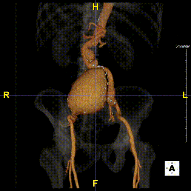 gore医疗怎么样「漫腹精论」髂合时宜 精益求精——双MOB球囊导管辅助腹主动脉覆膜支架急诊治疗破裂巨大髂动脉瘤_https://www.jmylbn.com_新闻资讯_第6张