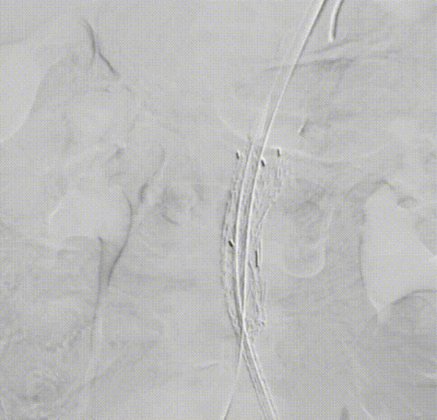 gore医疗怎么样「漫腹精论」髂合时宜 精益求精——双MOB球囊导管辅助腹主动脉覆膜支架急诊治疗破裂巨大髂动脉瘤_https://www.jmylbn.com_新闻资讯_第21张