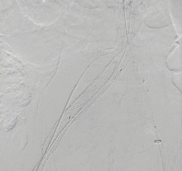 gore医疗怎么样「漫腹精论」髂合时宜 精益求精——双MOB球囊导管辅助腹主动脉覆膜支架急诊治疗破裂巨大髂动脉瘤_https://www.jmylbn.com_新闻资讯_第24张