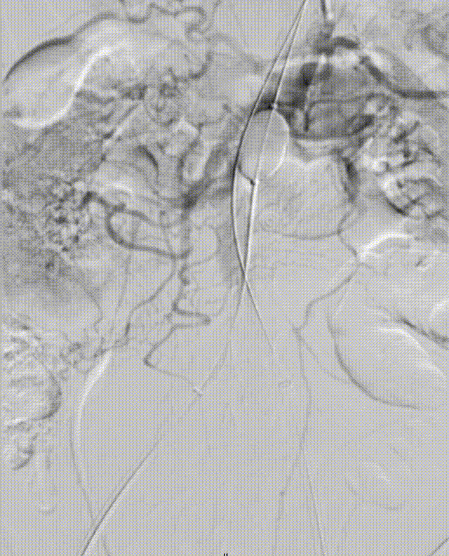 gore医疗怎么样「漫腹精论」髂合时宜 精益求精——双MOB球囊导管辅助腹主动脉覆膜支架急诊治疗破裂巨大髂动脉瘤_https://www.jmylbn.com_新闻资讯_第18张