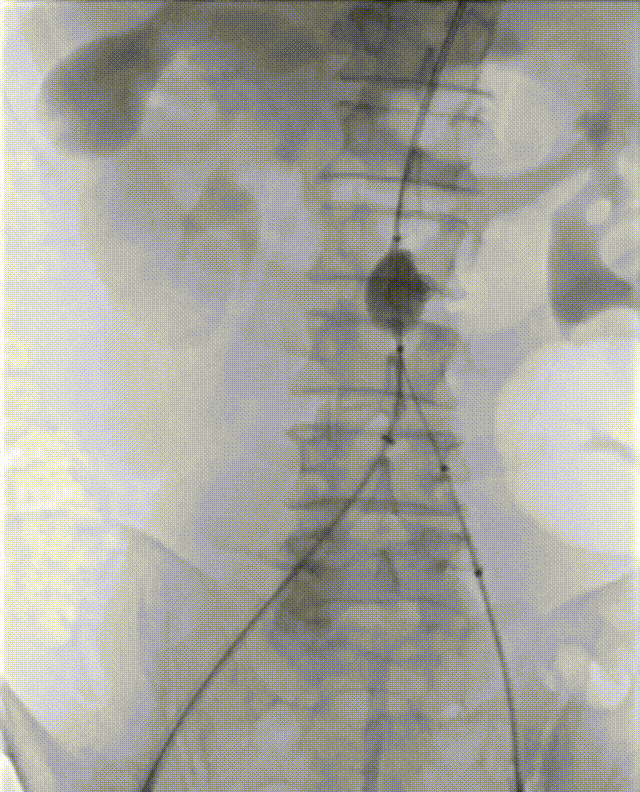 gore医疗怎么样「漫腹精论」髂合时宜 精益求精——双MOB球囊导管辅助腹主动脉覆膜支架急诊治疗破裂巨大髂动脉瘤_https://www.jmylbn.com_新闻资讯_第16张