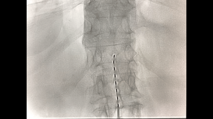 手电极怎么用手指一动就疼？金医疼痛病房用一根1.4毫米的电极解决顽固性神经痛_https://www.jmylbn.com_新闻资讯_第5张
