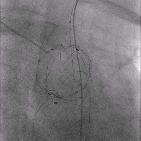 泥鳅导丝怎么用曲乐丰教授团队：0.018＂和0.035＂普通泥鳅导丝行胸主动脉弓上分支原位开窗的病例分享_https://www.jmylbn.com_新闻资讯_第15张