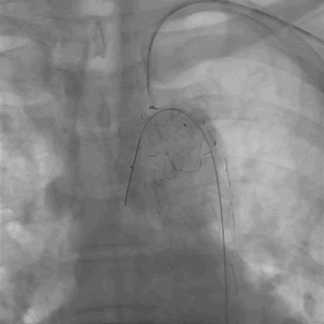 泥鳅导丝怎么用曲乐丰教授团队：0.018＂和0.035＂普通泥鳅导丝行胸主动脉弓上分支原位开窗的病例分享_https://www.jmylbn.com_新闻资讯_第34张