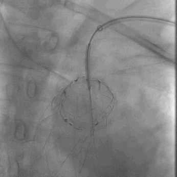 泥鳅导丝怎么用曲乐丰教授团队：0.018＂和0.035＂普通泥鳅导丝行胸主动脉弓上分支原位开窗的病例分享_https://www.jmylbn.com_新闻资讯_第18张